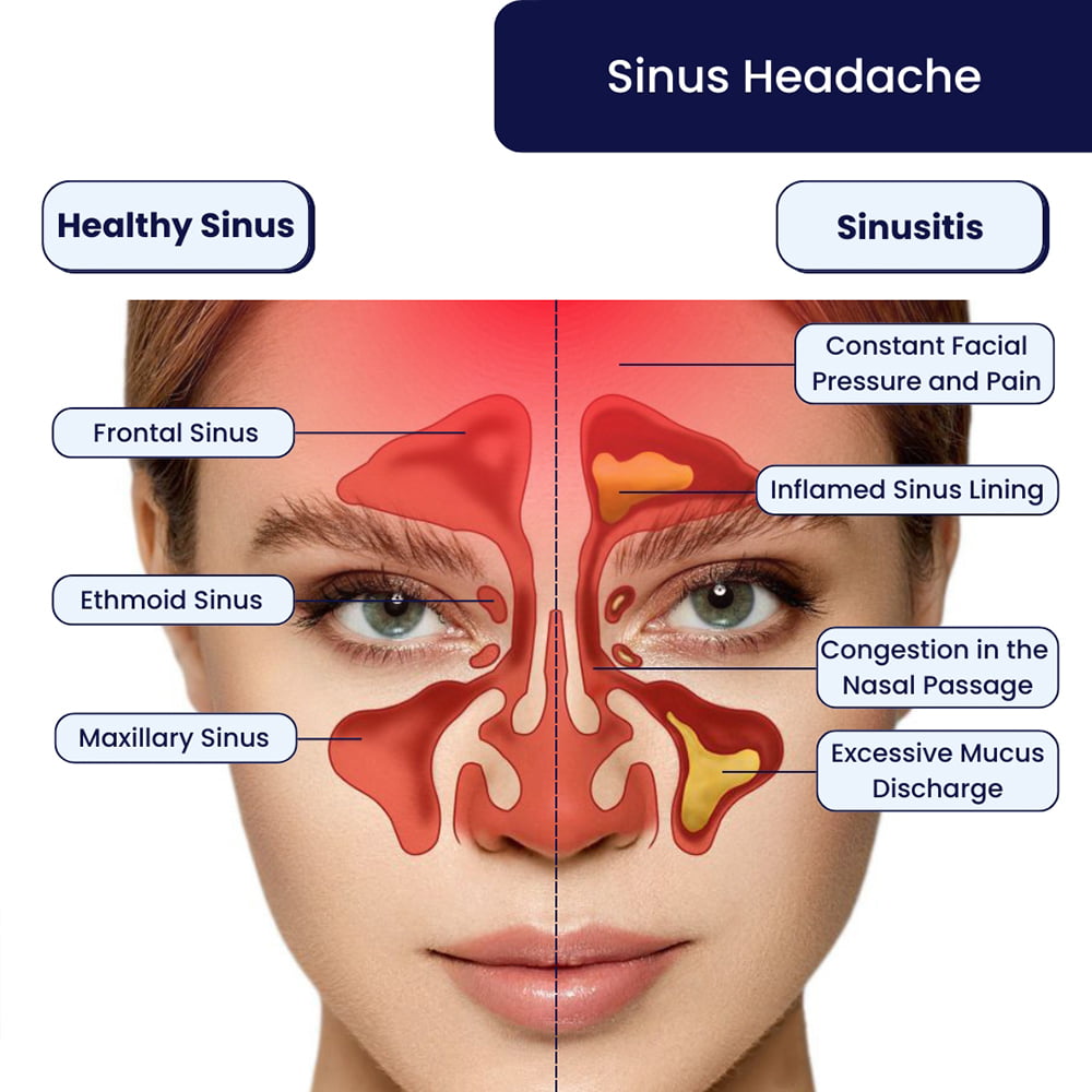 Proven methods for sinus headache relief