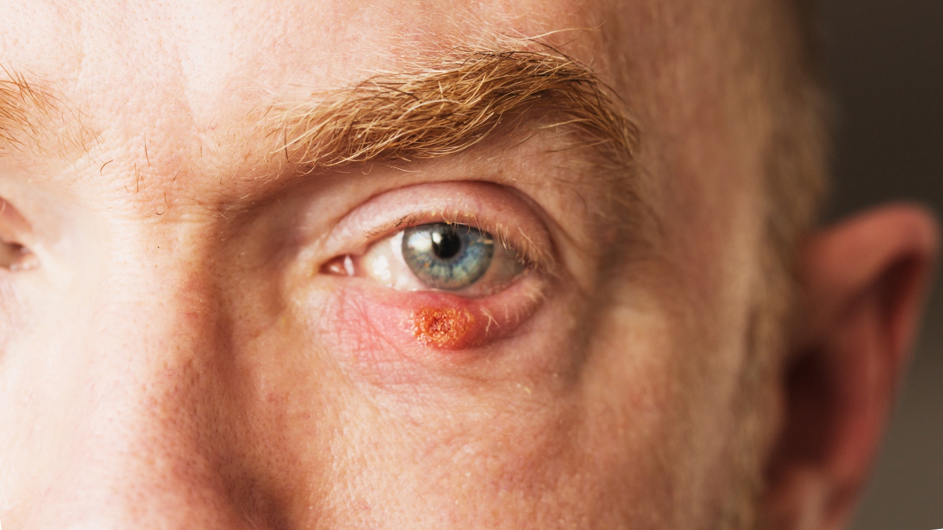 Natural Remedies for Stye Relief